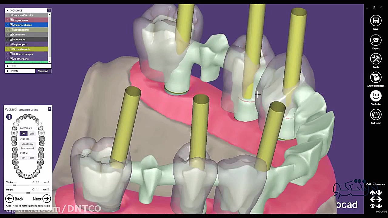 آموزش طراحی لثه مجازی (Virtual Gingiva) و وکساپ پان‌سیتوپنی