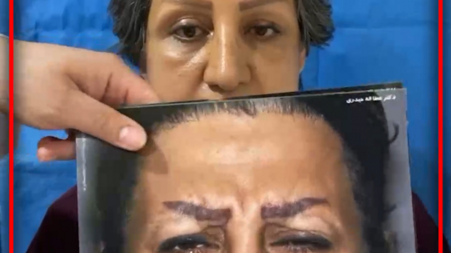 لیفت پیشانی به روش اندوسکوپی و لیفت صورت به روش اسمس Förster Resonance Energy Transfer Test