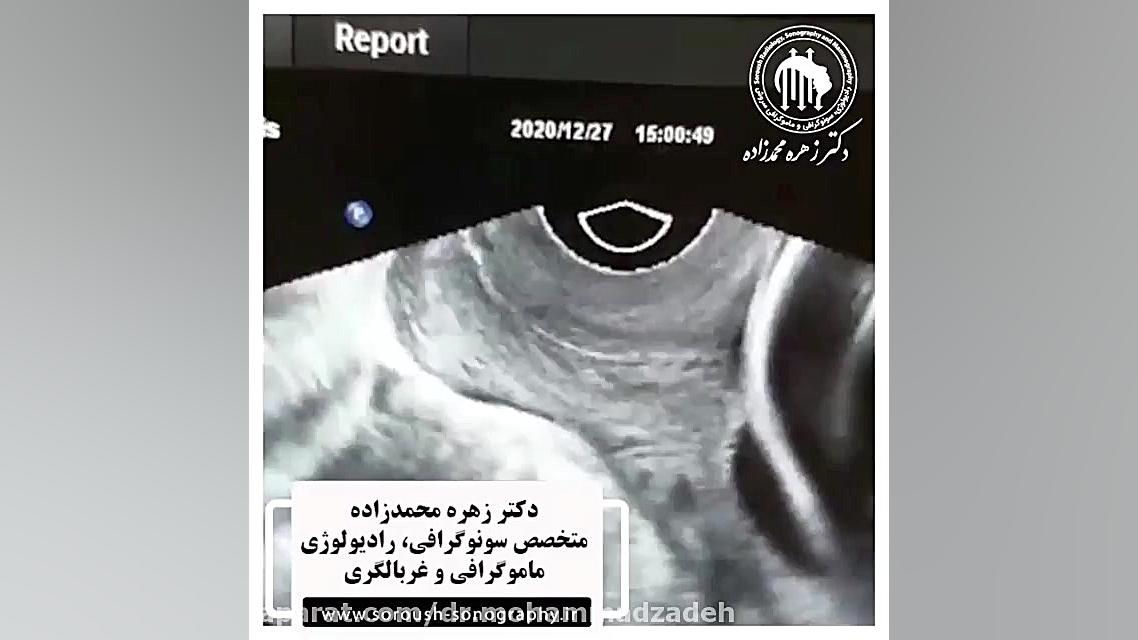 سونوگرافى كالر داپلر واژينال روکش دندان