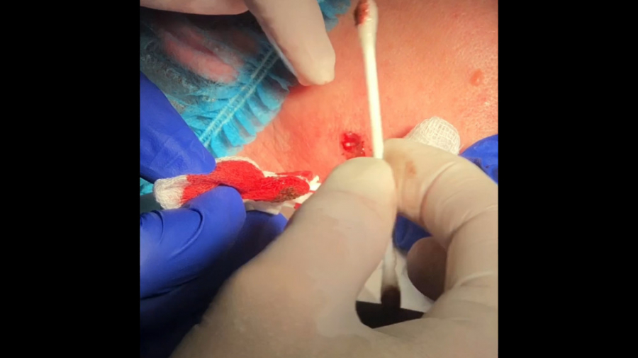 برداشتن خال.مهدی سطوتی