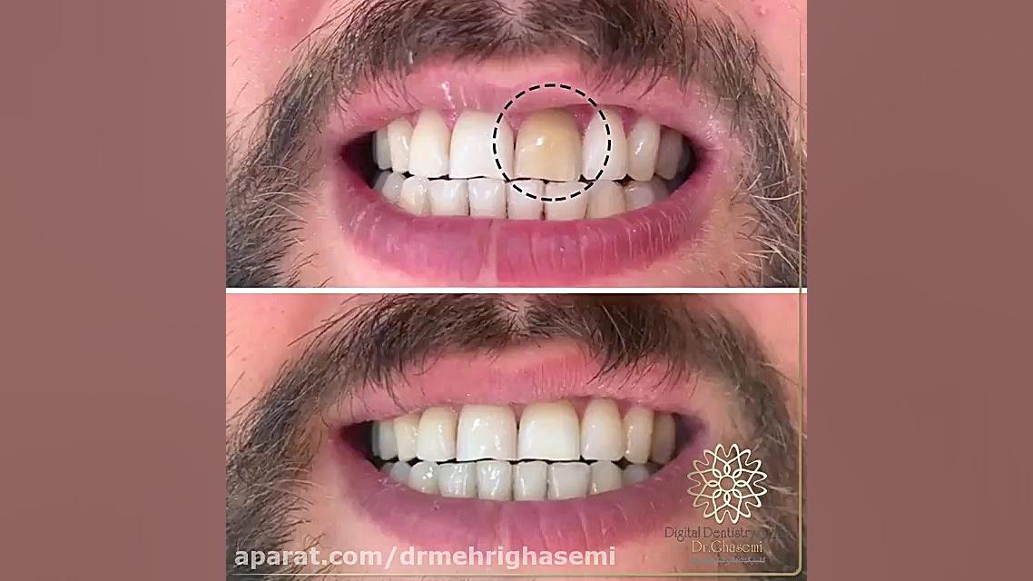 بازگرداندن زیبایی و رنگ طبیعی دندان | کلینیک دندانپزشکی دیجیتال دکتر مهری قاسمی مرکز دندانپزشکی دیجیتال دکتر مهری قاسمی
