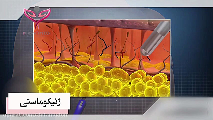 جراحی ژنیکوماستی اقایان بلیچینگ