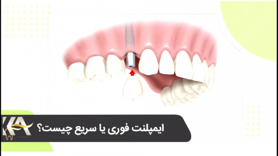 ایمپلنت فوری یا سریع چیست؟ دکتر کامیار عباسی
