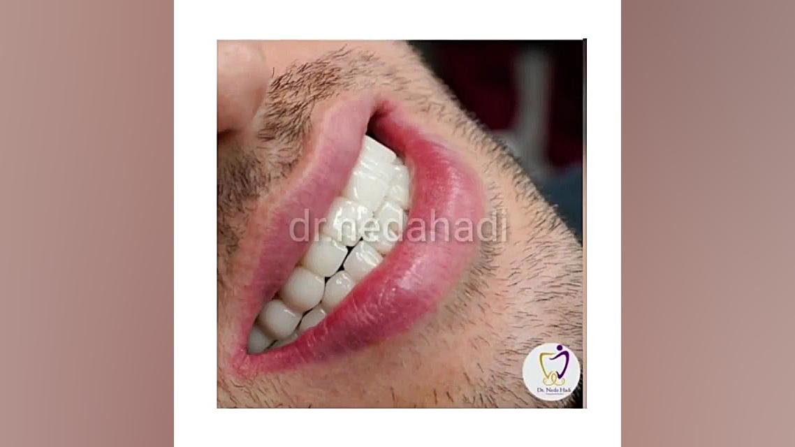 انجام کار زیبایی برای مراجعه کننده عزیز دکتر ندا هادی-دندانپزشک زیبایی