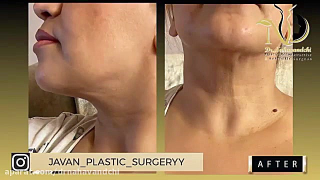 فیلم واقعی لیپوساکشن غبغب MRCP