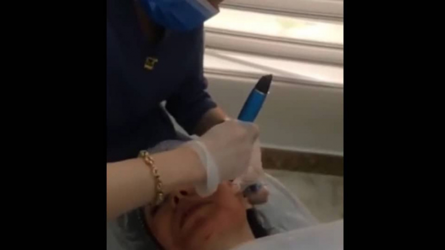 فیلم واقعی میکرونیدلینگ، معجزه جوانسازی صورت رادیوگرافی دندان