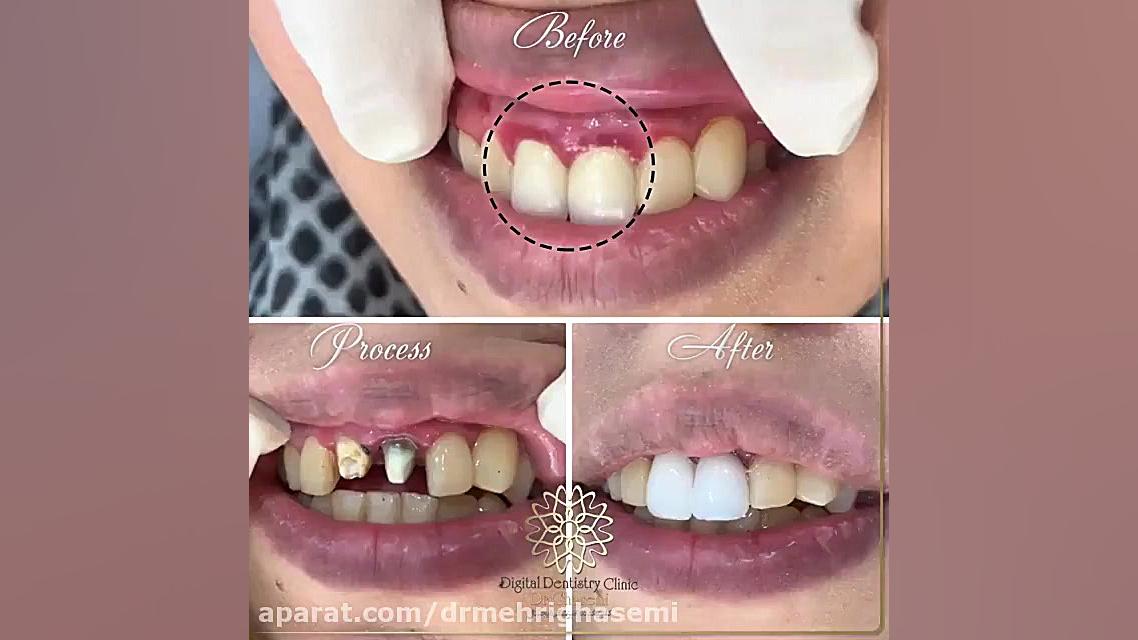 تعویض دو واحد روکش قدیمی | کلینیک دندانپزشکی دیجیتال دکتر مهری قاسمی مرکز دندانپزشکی دیجیتال دکتر مهری قاسمی