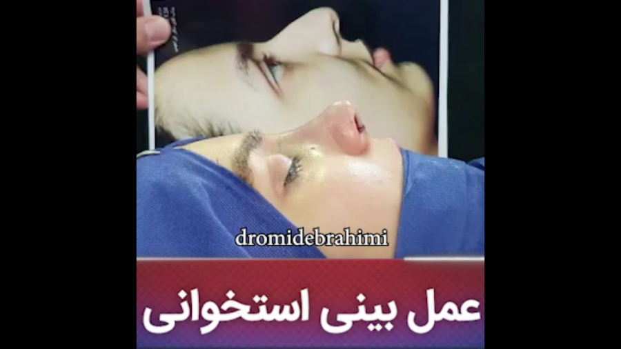 عمل بینی استخوانی توسط بهترین جراح بینی در تهران دکتر امید ابراهیمی دکتر امید ابراهیمی