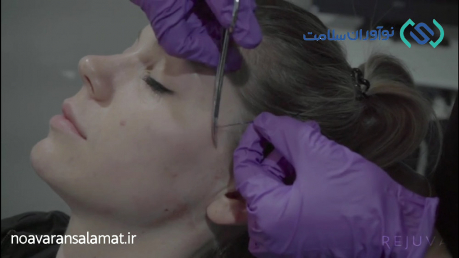 لیفت صورت با نخ برای شادابی پوست - نوآوران سلامت بیماری نوری آسیب ارثی
