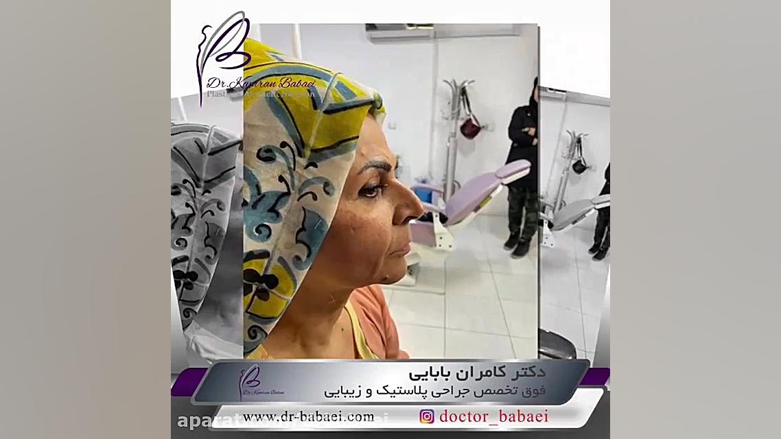 اندولیفت دکتر کامران بابایی