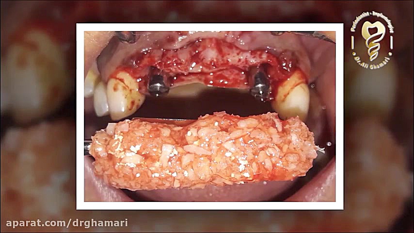 فیلم واقعی از بهترین روش ایمپلنت دندان دکتر علی قمری - متخصص جراحی لثه و ایمپلنت