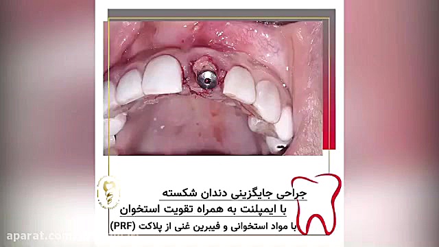 قبل از ایمپلنت دندان این فیلم را ببینید دکتر علی قمری - متخصص جراحی لثه و ایمپلنت