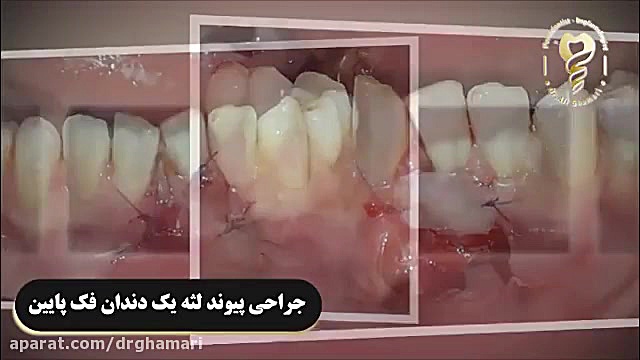 فیلم واقعی از جراحی پیوند لثه فک پایین دکتر علی قمری - متخصص جراحی لثه و ایمپلنت