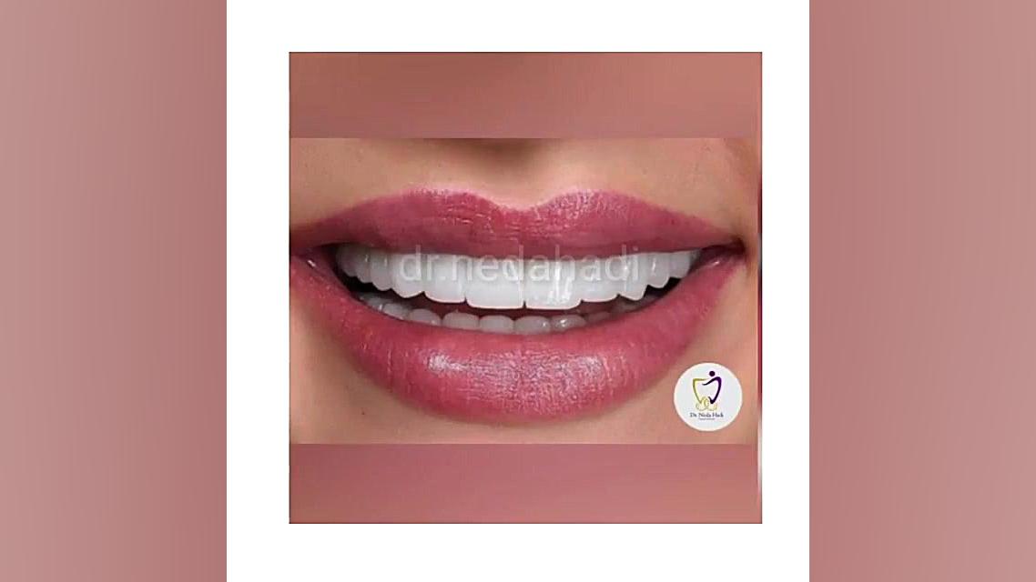 انجام کار زیبایی برای مراجعه کننده عزیزم دکتر ندا هادی-دندانپزشک زیبایی