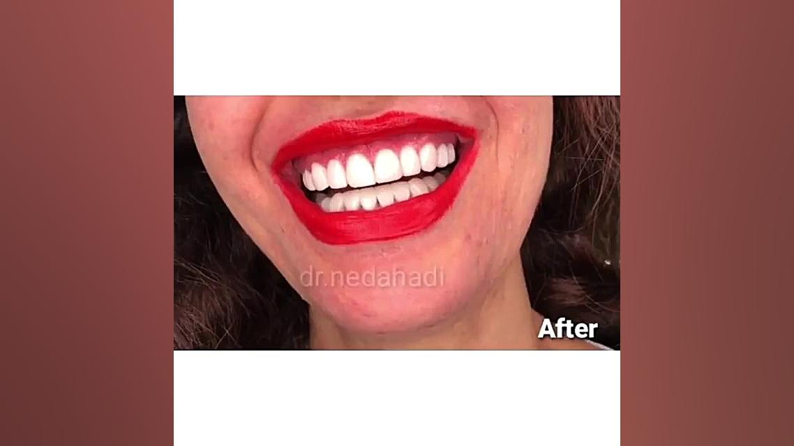 لبخند و رضايت زیباجوی عزیزمون دکتر ندا هادی-دندانپزشک زیبایی