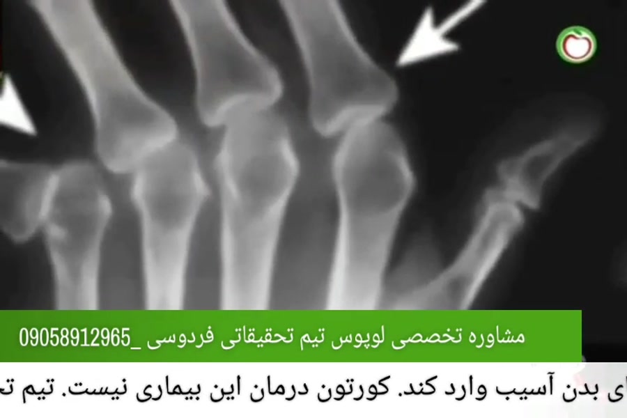 درمان لوپوس خطرناک ترین بیماری خودایمنی برنامه زنده درمان لوپوس خطرناک ترین بیماری خودایمنی برنامه زنده