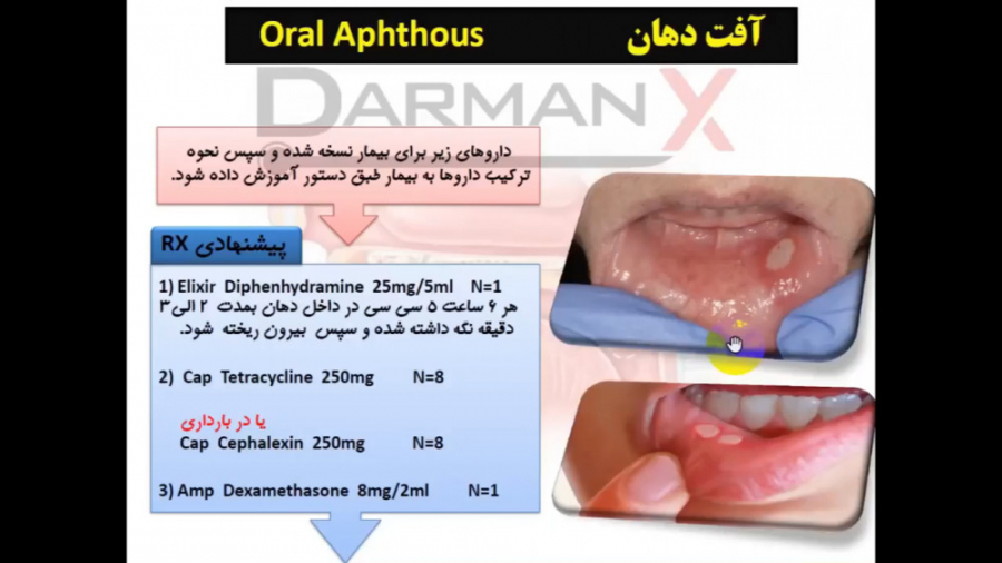 آموزش گوش، حلق و بینی (نسخه، اوردر، اپروچ، آزمایشات و...)(آفت دهان) جراحی پف زیر چشم