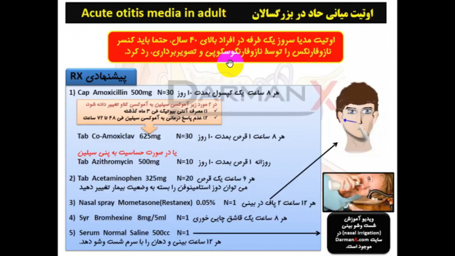 آموزش گوش، حلق و بینی (نسخه، اوردر، اپروچ)(نسخه اوتیت میانی حاد بزرگسالان) ترمیم ونیر