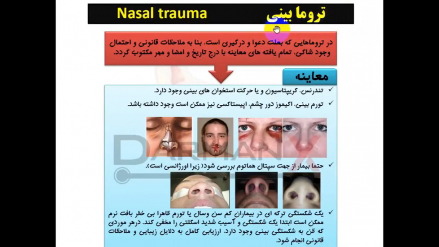 آموزش گوش، حلق و بینی (نسخه، اوردر، اپروچ، آزمایشات و...)(تروما بینی) لیپوساکشن