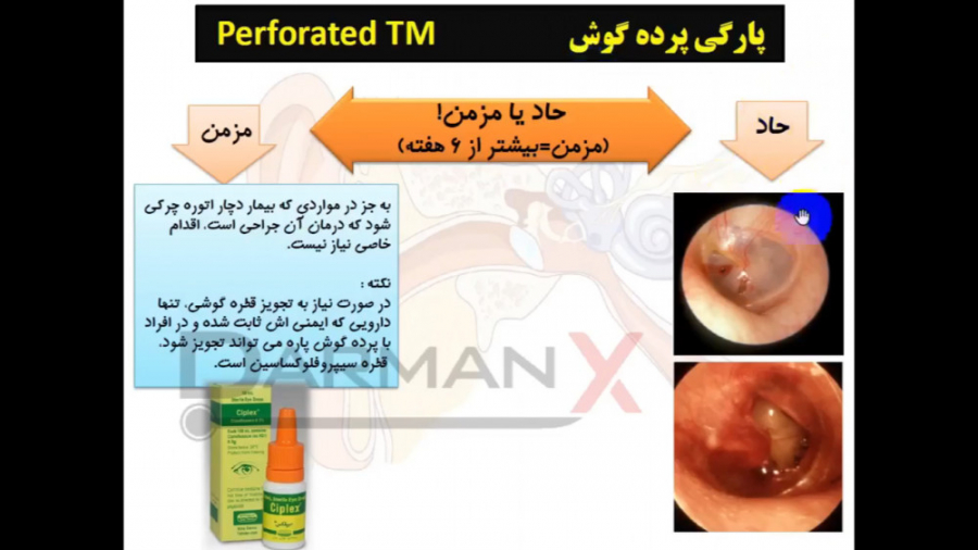 آموزش گوش، حلق و بینی (نسخه، اوردر، اپروچ، آزمایشات و...)(پارگی پرده گوش) درمان جای جوش