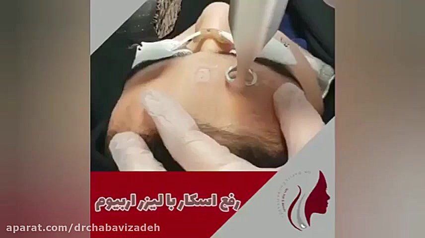 فیلم رفع اسکار با لیزر اربیوم دکتر صفیه چعباوی زاده