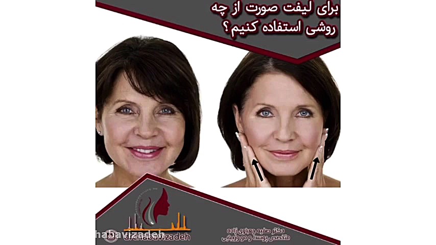 صفر تا صد لیفت صورت دکتر صفیه چعباوی زاده