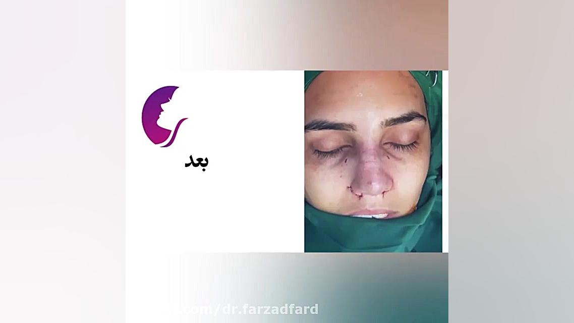 جراحی زیبایی بینی از دکتر اسماعیل فرزاد فرد دکتر اسماعیل فرزاد فرد - فوق تخصص پلاستیک