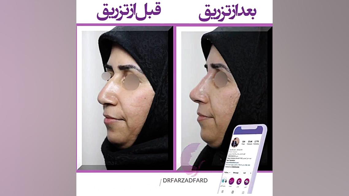 تزریق ژل به بینی جهت اصلاح فرم بینی دکتر اسماعیل فرزاد فرد - فوق تخصص پلاستیک