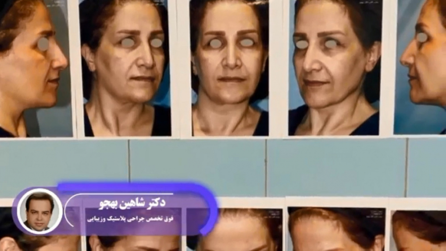 لیفت صورت،شقیقه،گردن و بلفاروپلاستی پلک پایین و تزریق چربی به صورت بررسی سطح اسید لاکتیک خون