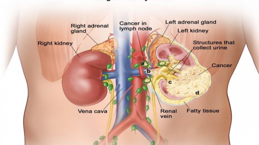 درمانهای جدید سرطان متاستاتیک کلیه Metastatic Renal Cell Carcinoma دکتر احمد مافی (انکولوژیست)