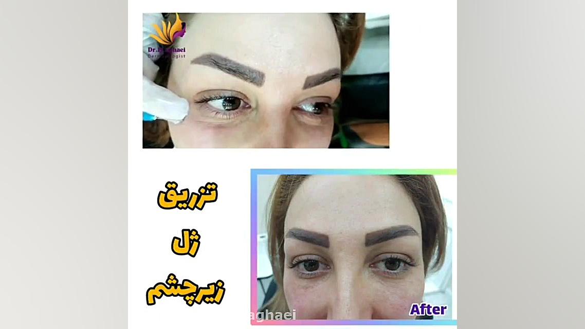 فیلم تزریق ژل زیر چشم دکتر حمیده آقایی