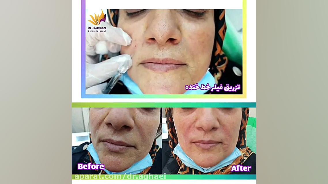 فیلم تزریق فیلر به خط خنده دکتر حمیده آقایی