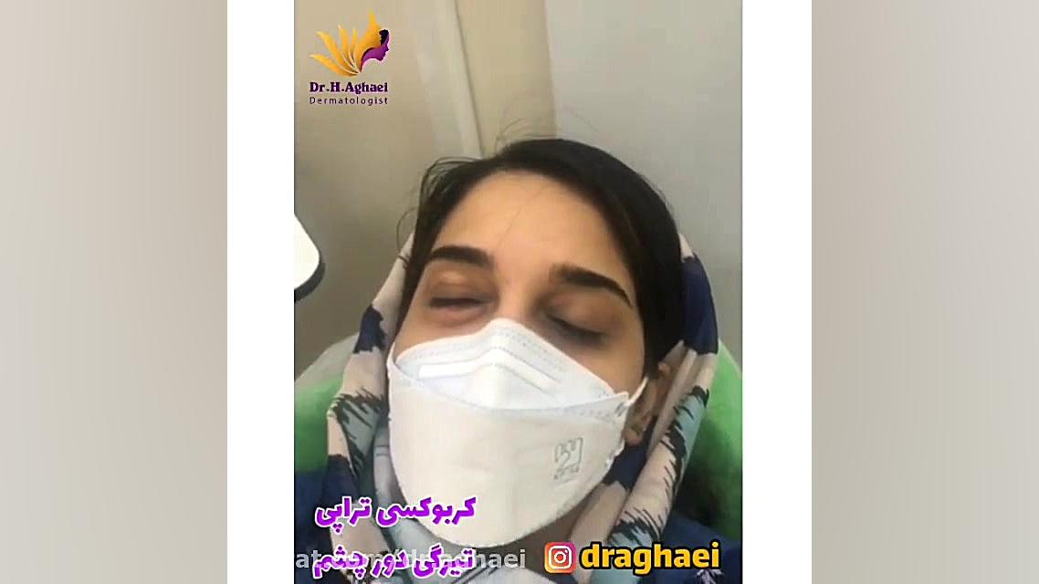 فیلم کربوکسی تراپی دور چشم دکتر حمیده آقایی