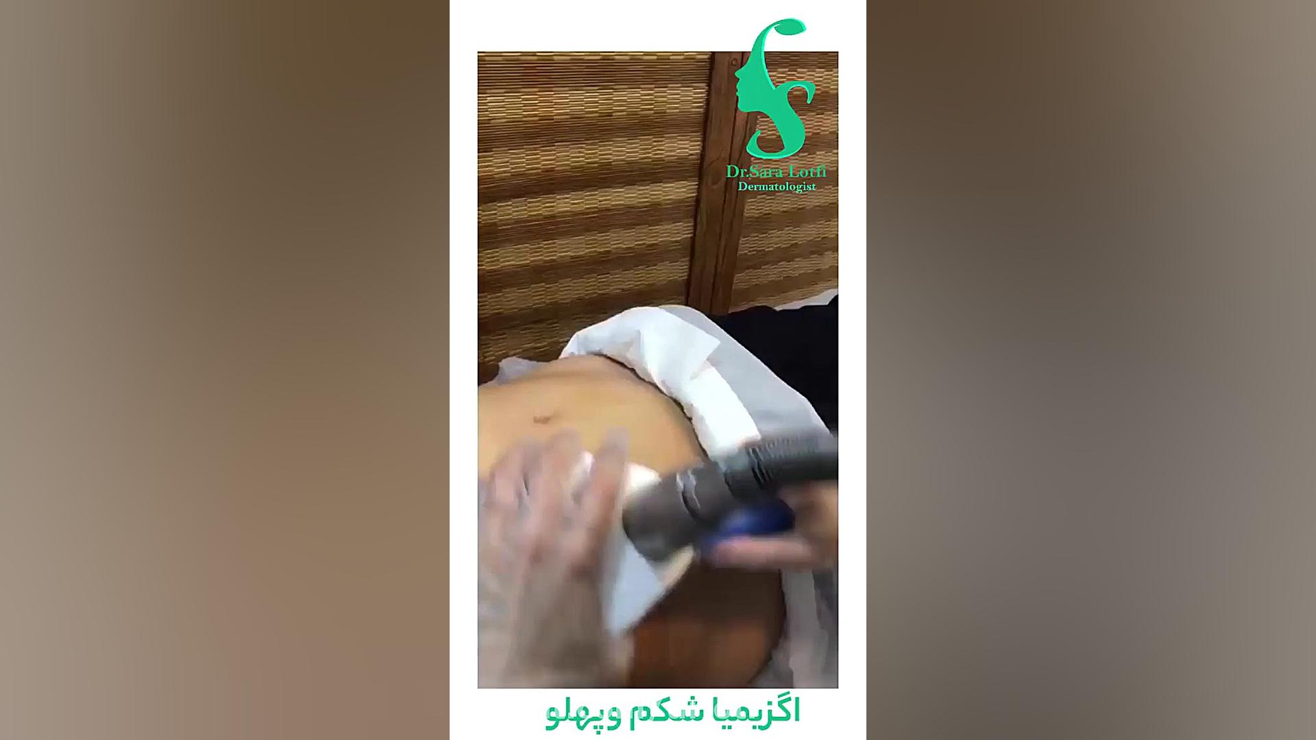 نتیجه عالی از اگزیمیا شکم پهلو برای لاغری موضعی دکتر سار ا لطفی