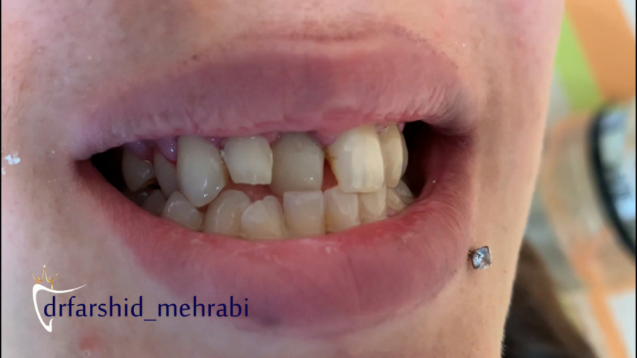 فیلم لمینت دندان پلتفرم مدلسازی بیماری in vitro