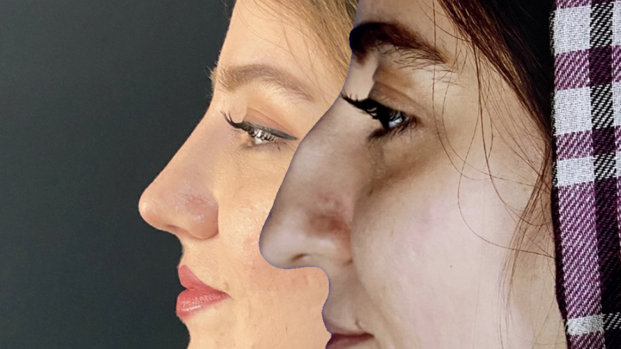 عمل جراحی زیبایی بینی استخوانی بزرگ