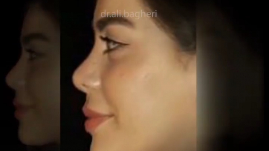 نمونه کار جراحی بینی دکتر علی باقری حق