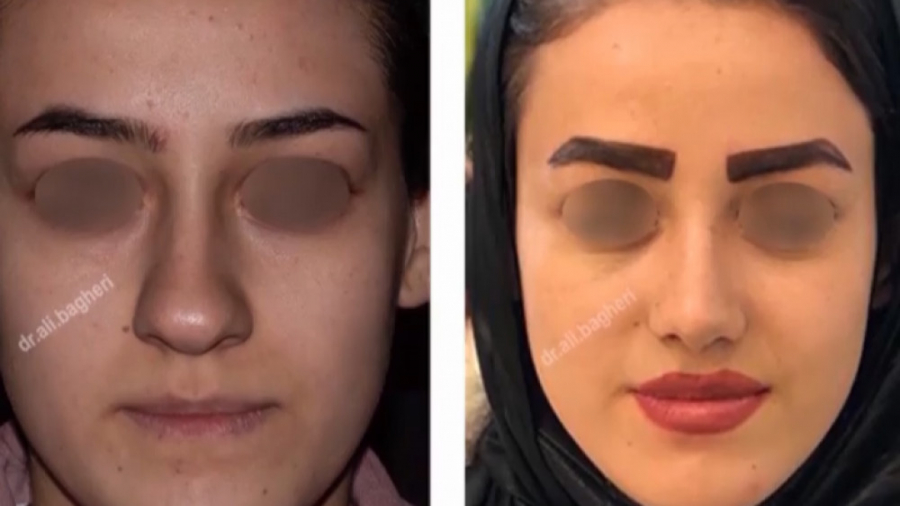 ویدئو قبل و بعد جراحی بینی دکتر علی باقری حق