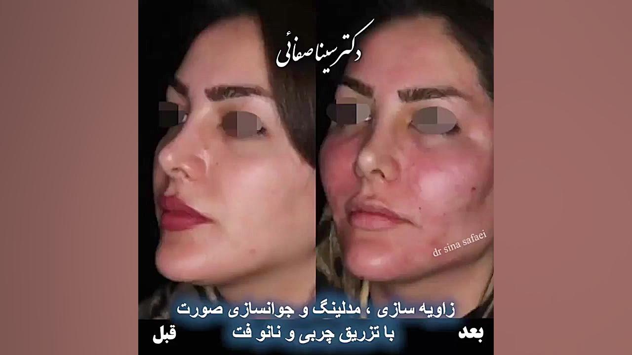 زاویه سازی و جوانسازی صورت با تزریق چربی و نانو فت کلونیک اسپاسم