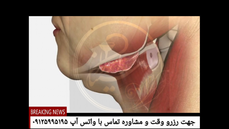 آنچه باید درباره لیفت صورت و گردن بدانیم!!!؟؟؟ تست تراشه ژنی
