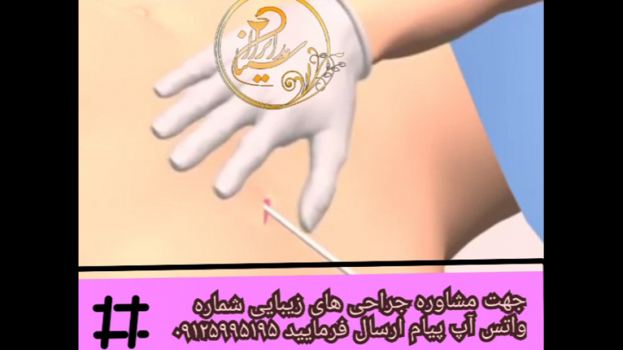 درباره جراحی لیپوماتیک بیشتر بدانیم!!!؟؟؟ ایمونوانژیوگرافی