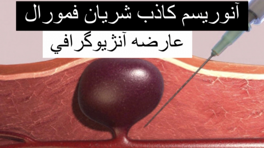 آنوریسم كاذب فمورال بدنبال آنژیوگرافی جراحی گوش