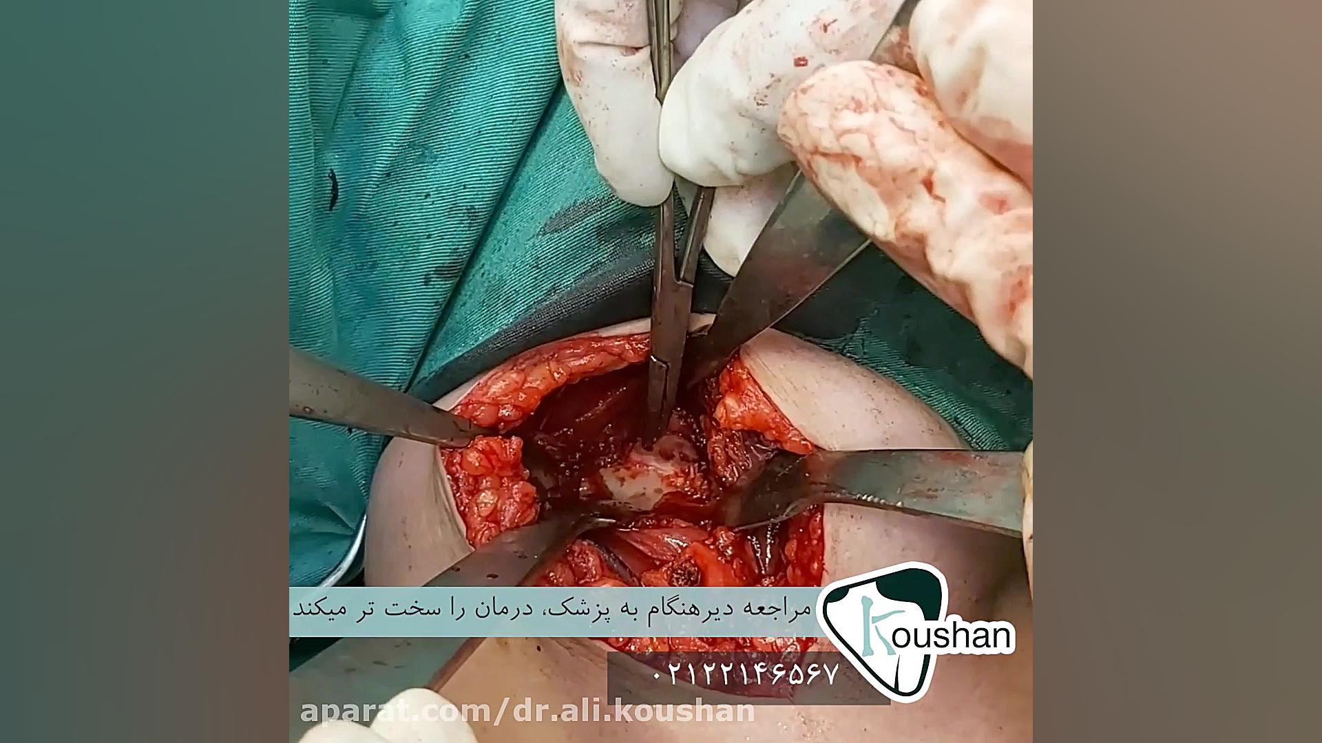 جراحی دررفتگی مکرر شانه توسط دکتر علی کوشان - فوق تخصص جراحی شانه اینفلوئنسر بامزه