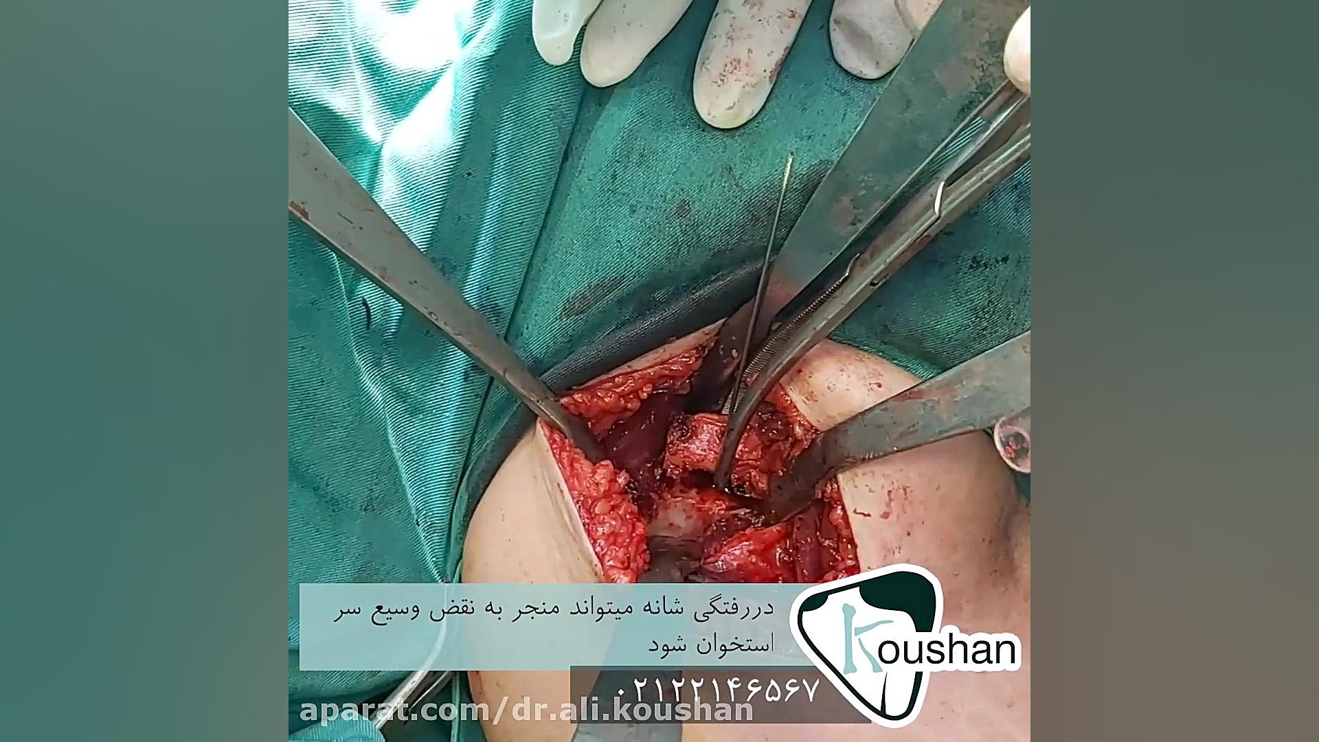 جراحی دررفتگی مکرر شانه عصب‌کشی