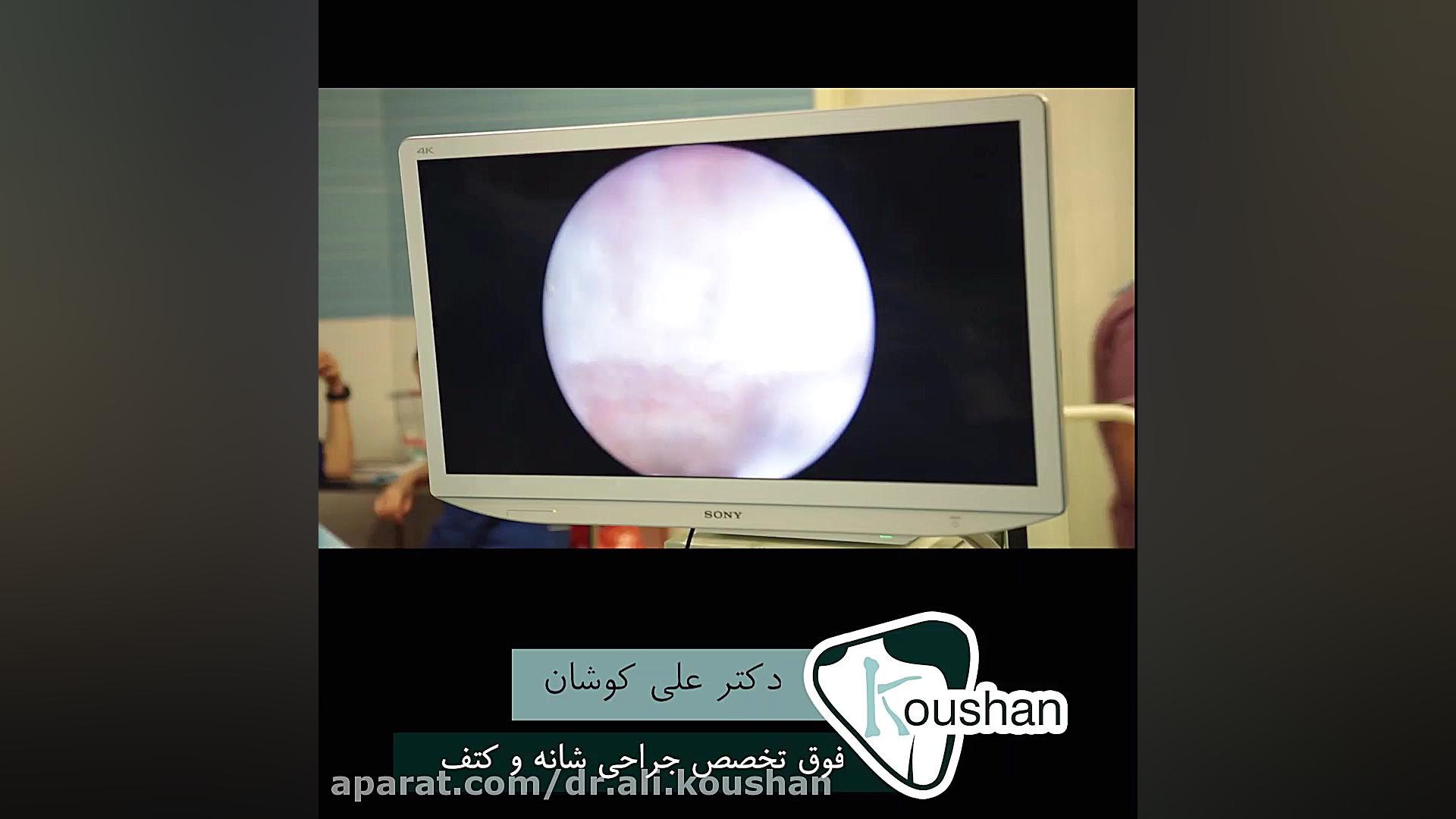 جراحی دررفتگی شانه به خاطر تشنج عمل زیبایی