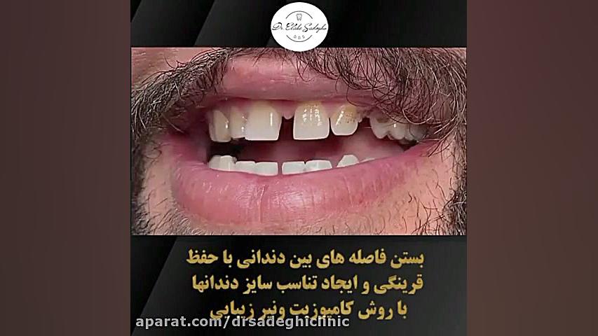 کامپوزیت ونیر در تهران | کامپوزیت زیبایی در زعفرانیه | کلینیک دکتر الهه صادقی بیماری ترومبوسایتوز اسنشیال