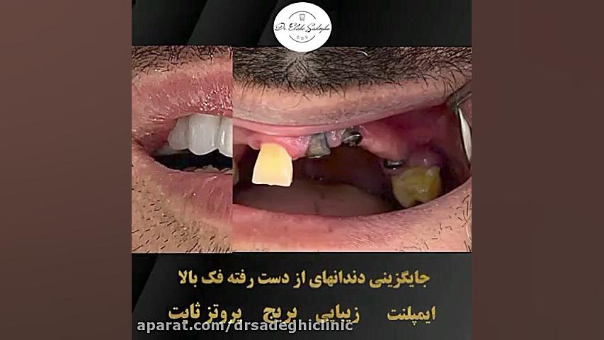 جایگزینی دندان های از دست رفته فک بالا در شمال تهران | دندانپزشکی دکتر صادقی مایکروگناتیا