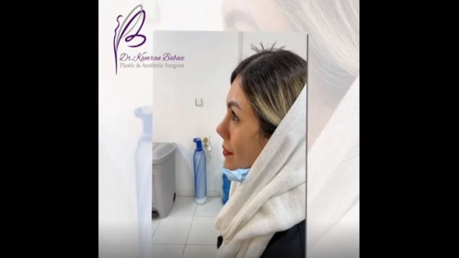 3 ماه بعد از جراحی زیبایی بینی دکتر کامران بابایی