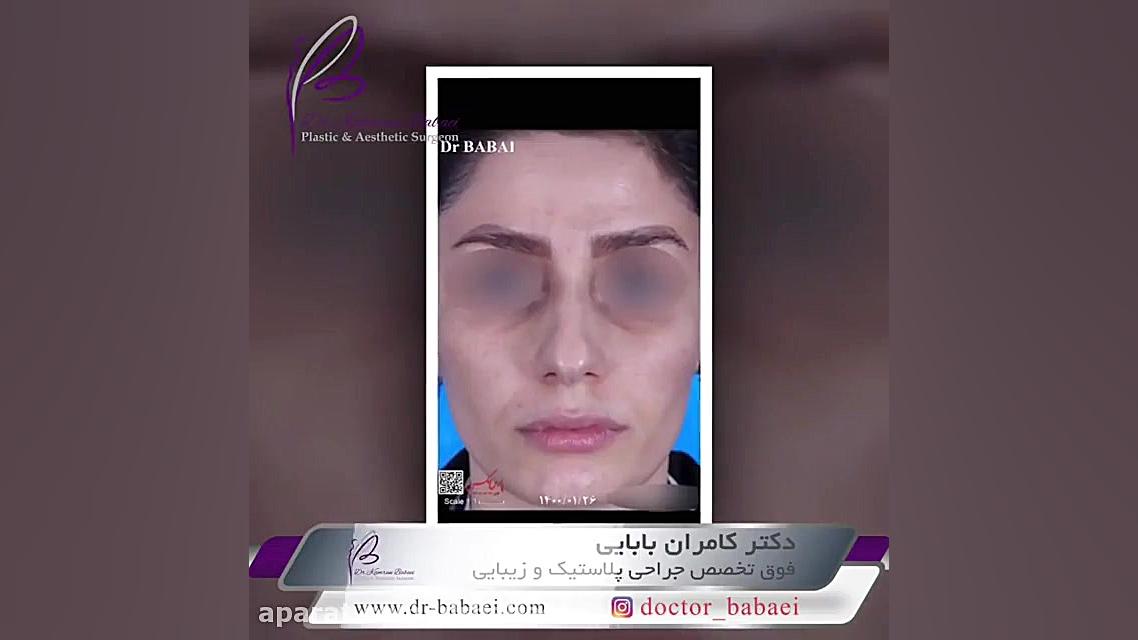 فیلم قبل و بعد عمل بینی دکتر کامران بابایی