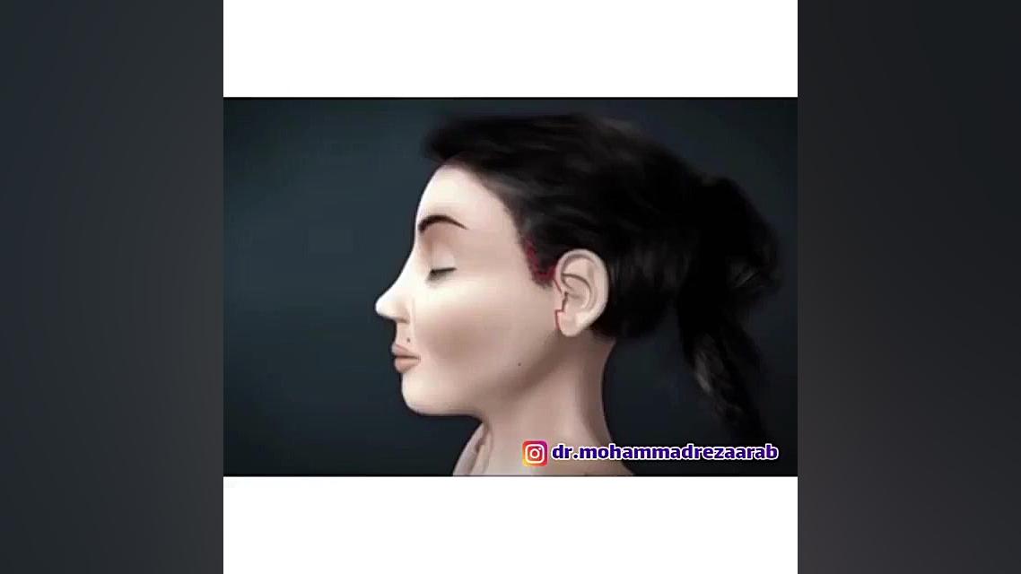 جراحى ليفت صورت زیبایی پوست